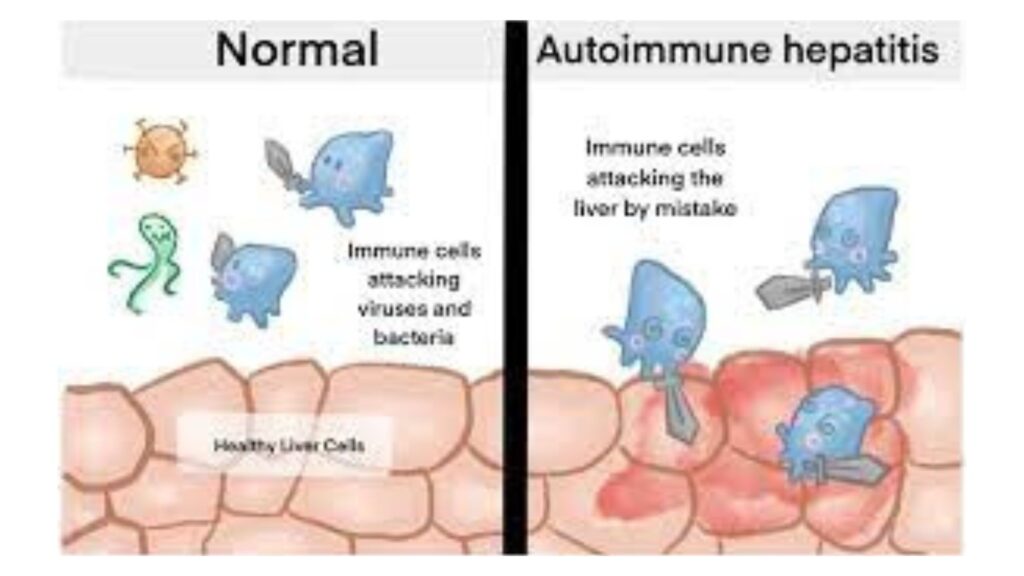 hepatitis autoimmune diseases